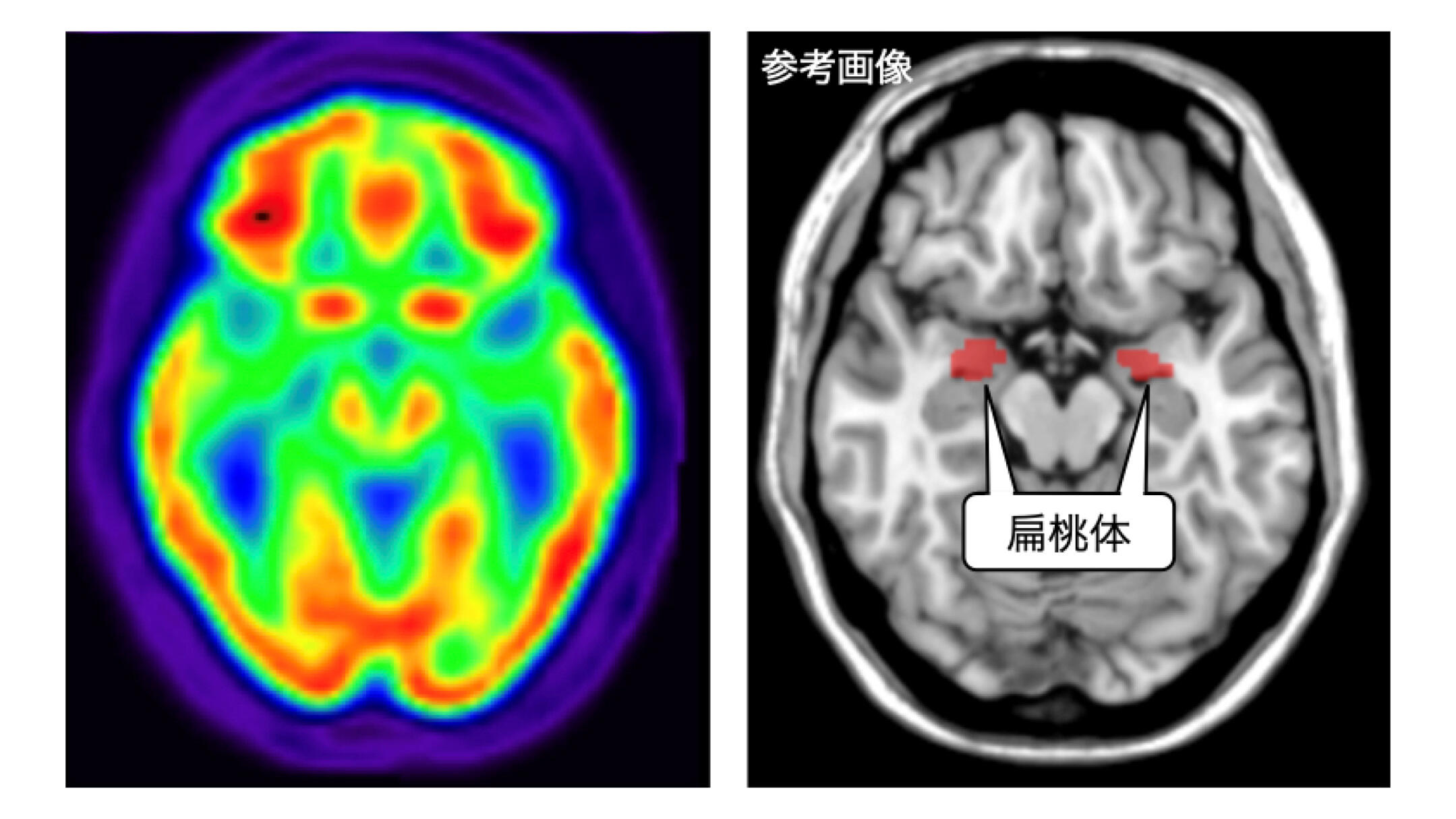Relation between resting amygdala activity and cardiovascular events in patients with cardiac sarcoidosis