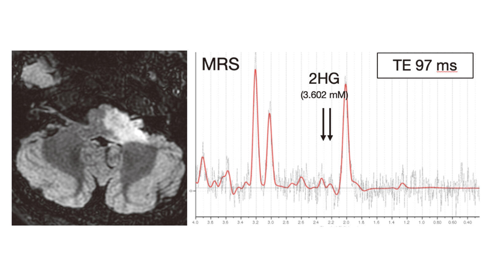 Temozolomide and radiation treatment lead to dramatic tumor shrinkage and improvement of hearing in an adult brainstem glioma patient with a rare IDH2 mutation