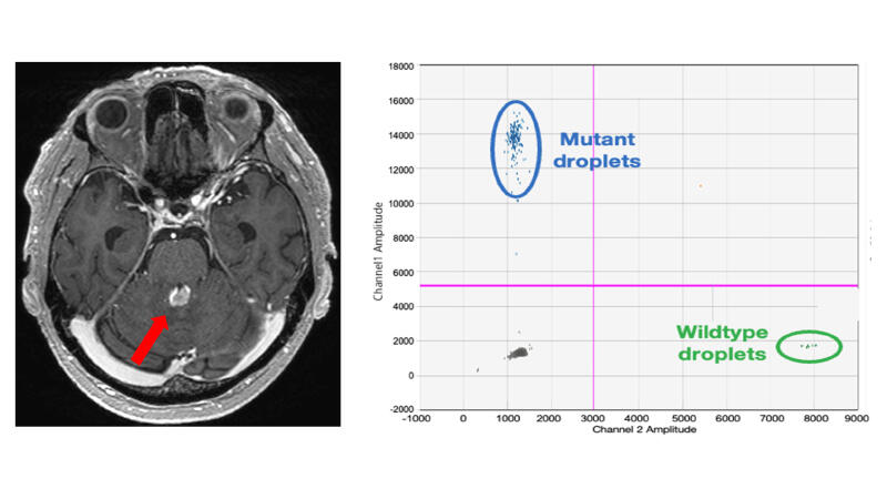 Treatment initiation is possible with a positive liquid biopsy in primary central nervous lymphoma patients with difficult-to-access lesions