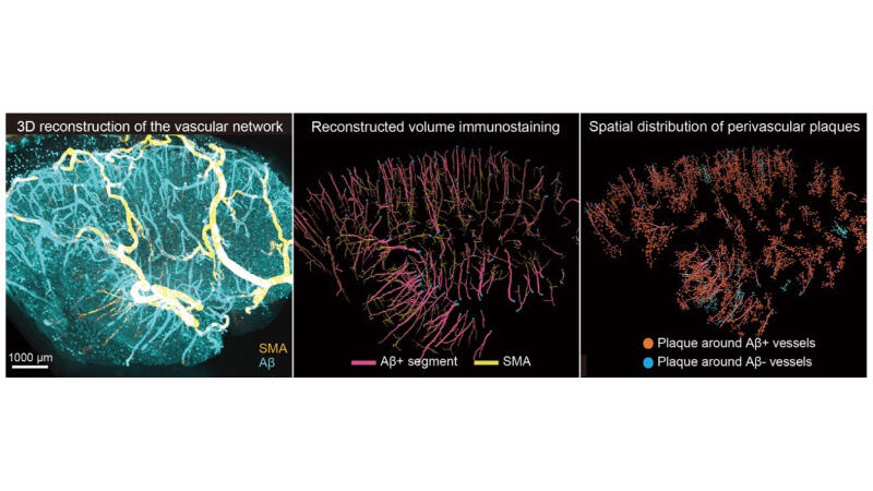 From surface to depth: 3D imaging traces vascular amyloid spread in the human brain