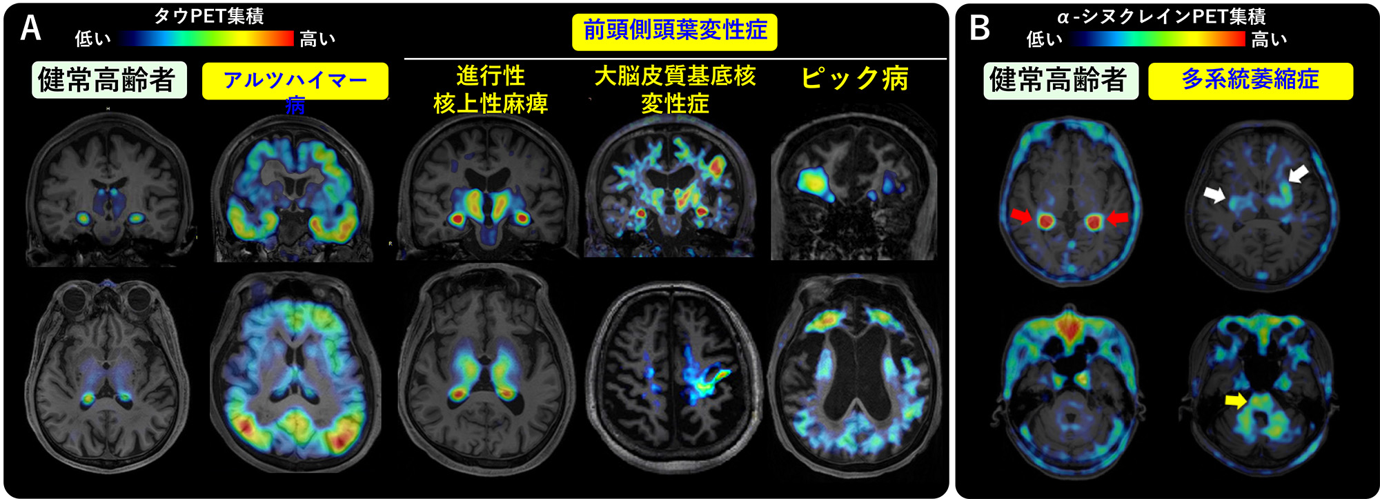 健康的な加齢脳と疾患脳の違いはどこにあるのか? | 脳研コラム | 新潟大学脳研究所(脳研)