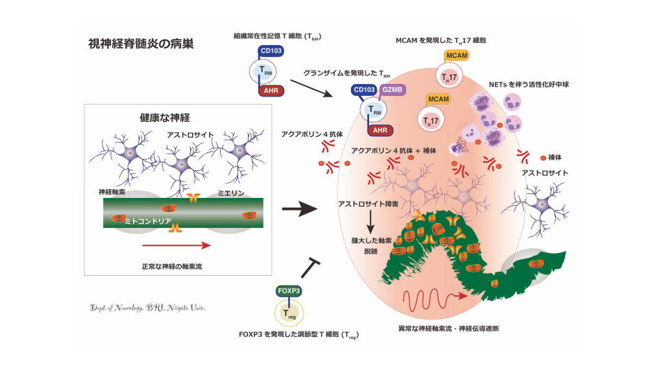 指定難病「視神経脊髄炎」の炎症を正負に制御する免疫ダイナミクスを発見 － 好中球とT細胞制御を目指した新たな治療法に道 －