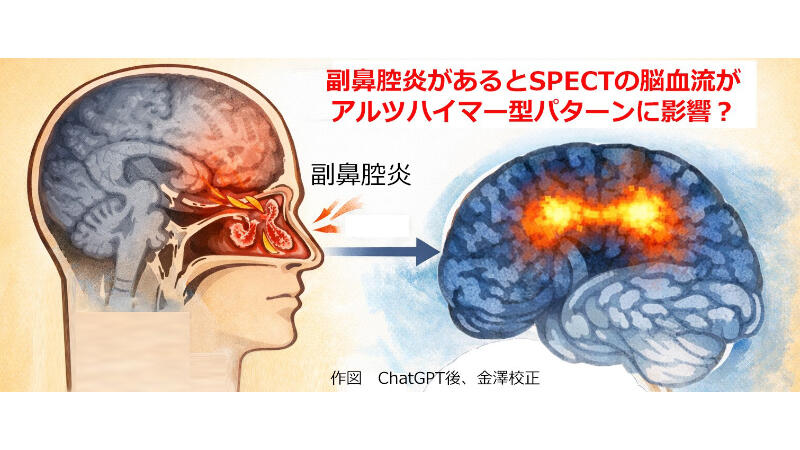 慢性副鼻腔炎が認知症の画像診断に影響する可能性―脳の検査の見方に新たな視点―