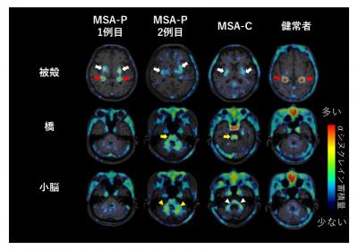 多系統萎縮症患者と健常高齢者における α シヌクレイン蓄積画像の比較